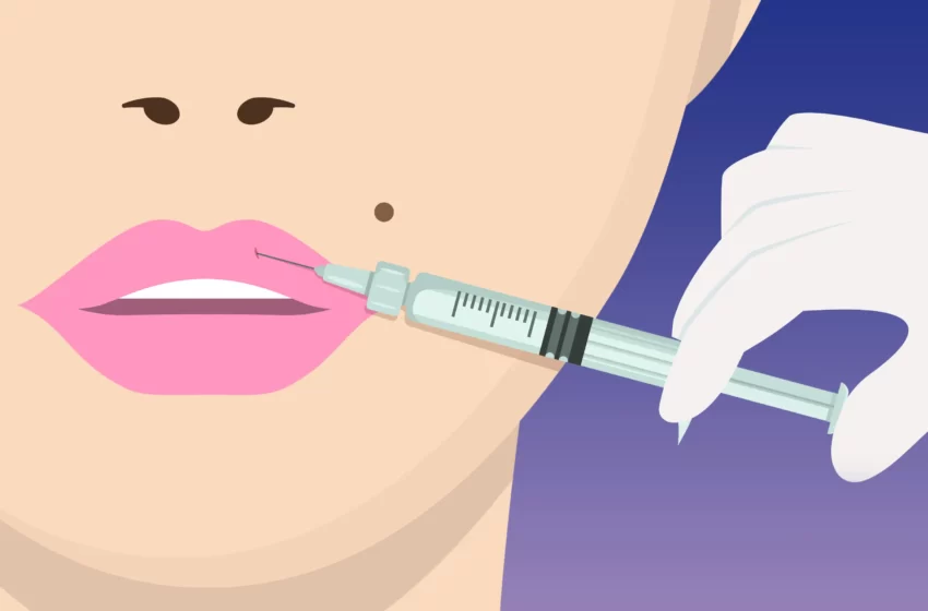  Everything You Need To Know About Lip Fillers